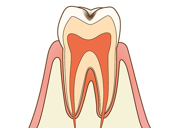 C1：エナメル質のむし歯