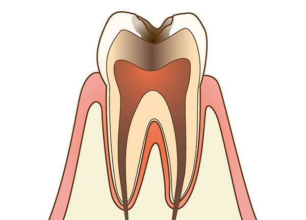 C3：神経に達したむし歯
