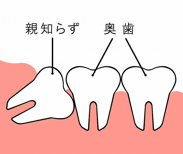 抜く方が望ましい親知らず