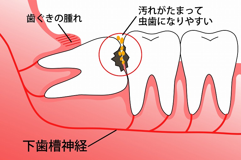 むし歯や歯周病が進行している