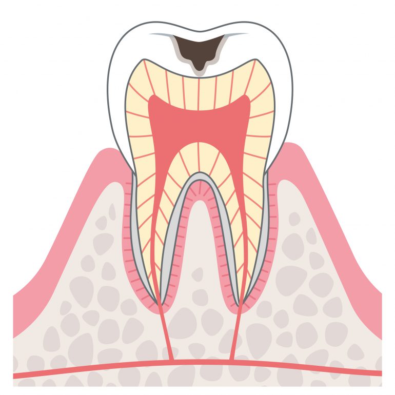 C2 むし歯